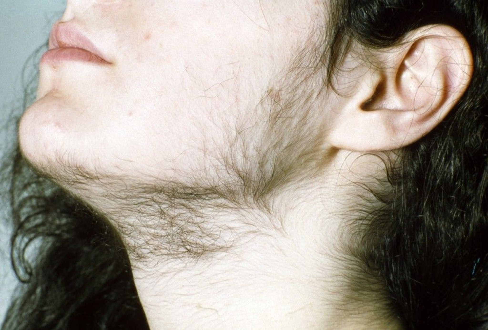 Hirsutism