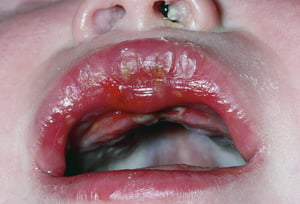 Mundgeschwüre bei Herpes-simplex-Virusinfektion
