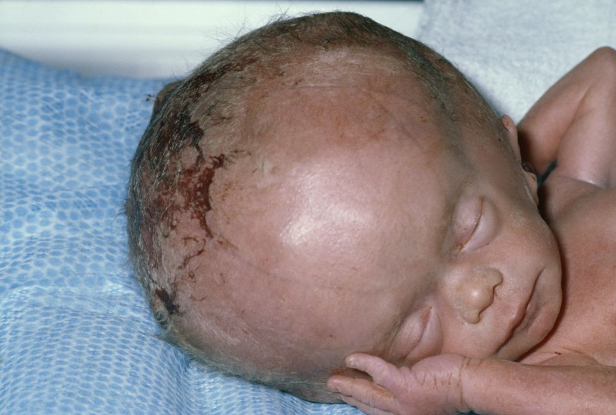 مَوَه الرَّأس hydrocephalus