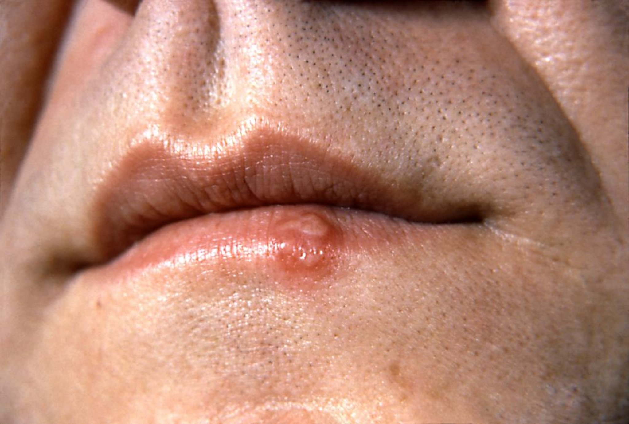 Bouton de fièvre