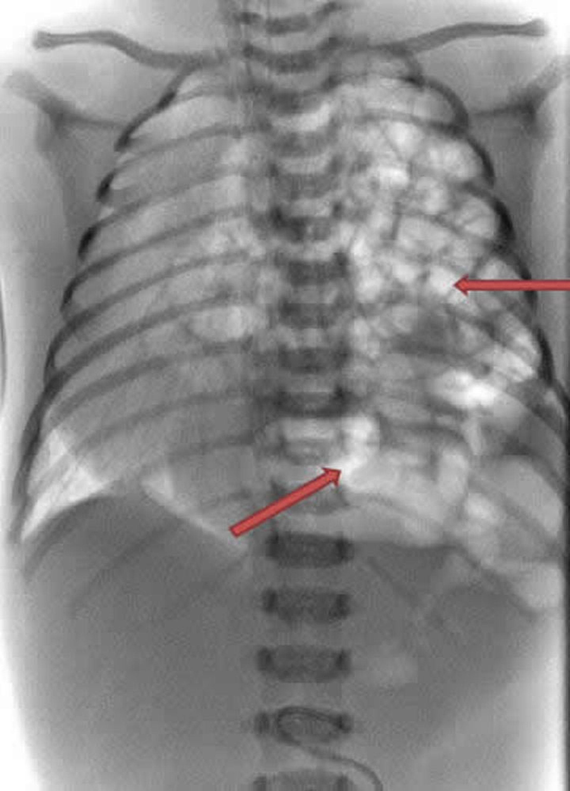 Diaphragmatic Hernia