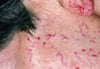Telangiectasia hemorrágica hereditaria (Cara)