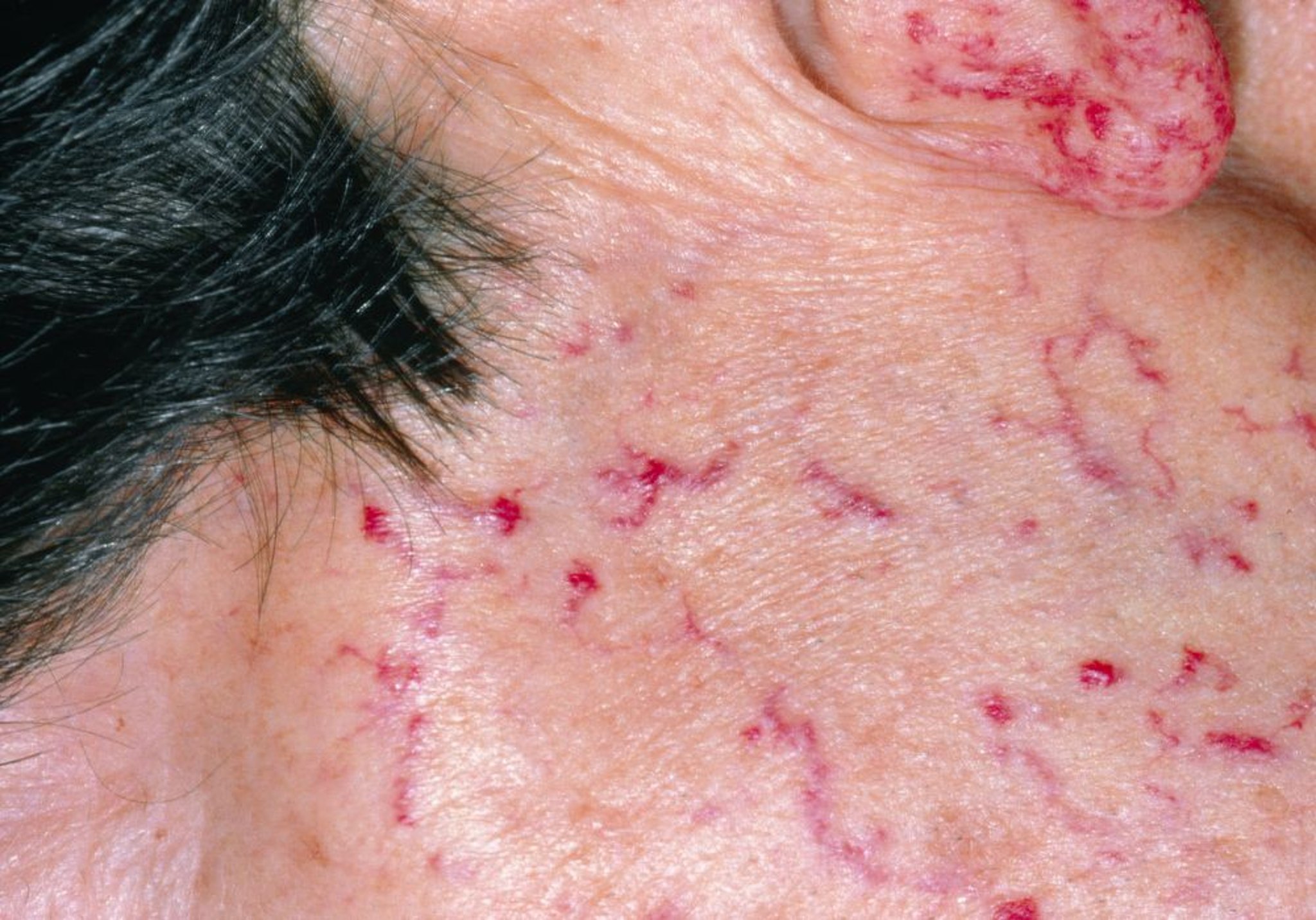 Telangiectasia hemorrágica hereditaria (Cara)