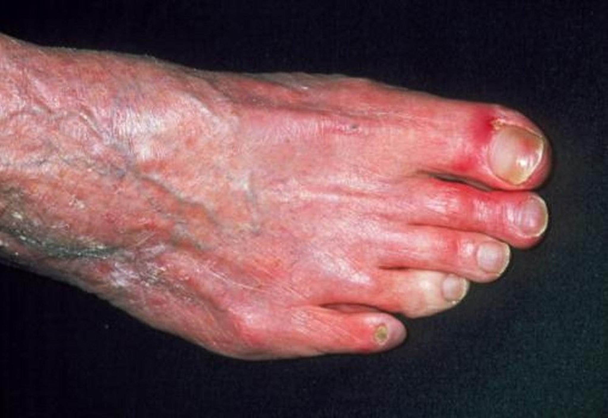 Peripheral Arterial Disease (Skin Changes)