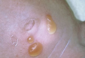 Impetigo bolhoso