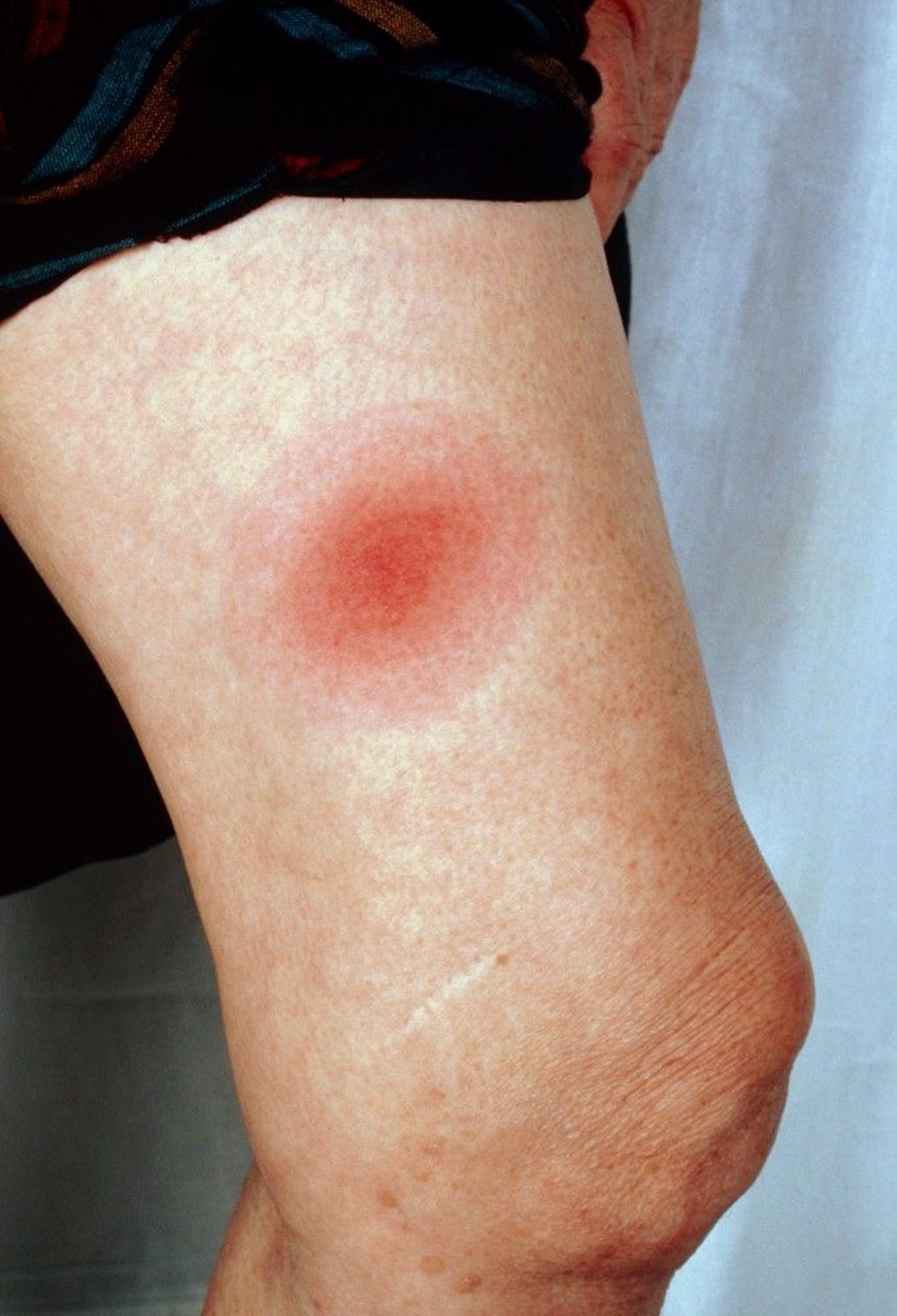 A Variation of the Rash of Lyme Disease (Erythema Migrans)