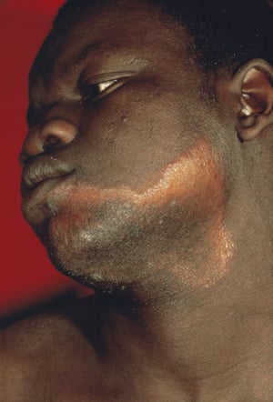 Tuberkuloide Lepra