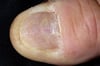 Lichen ruber planus des Nagels