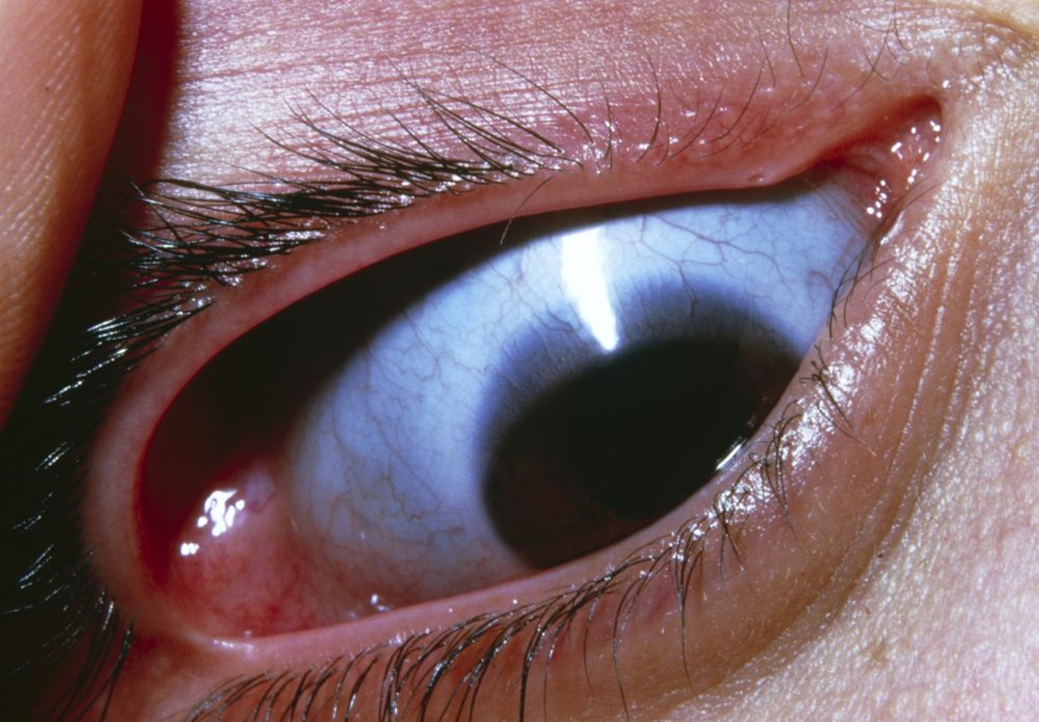 Ostéogenèse imparfaite (sclère bleue)