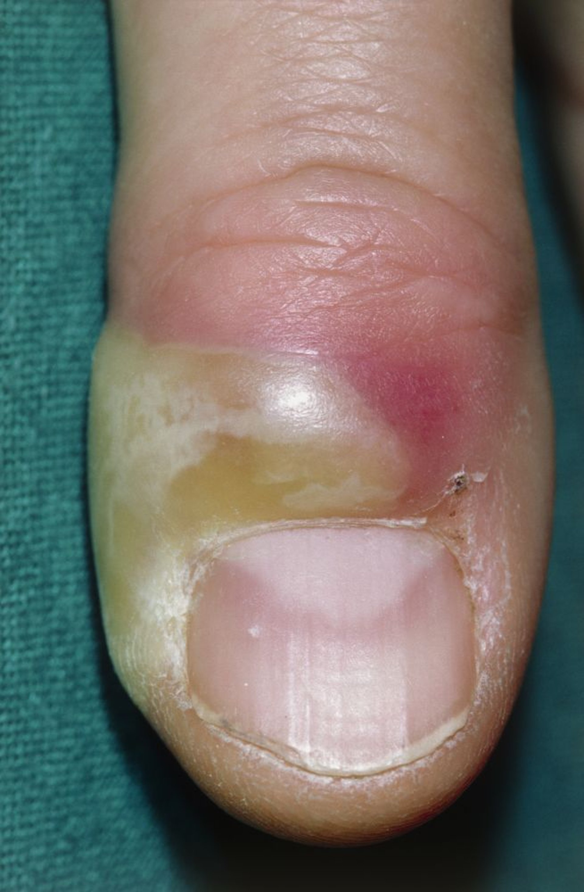 Akute Paronychie an einem Finger