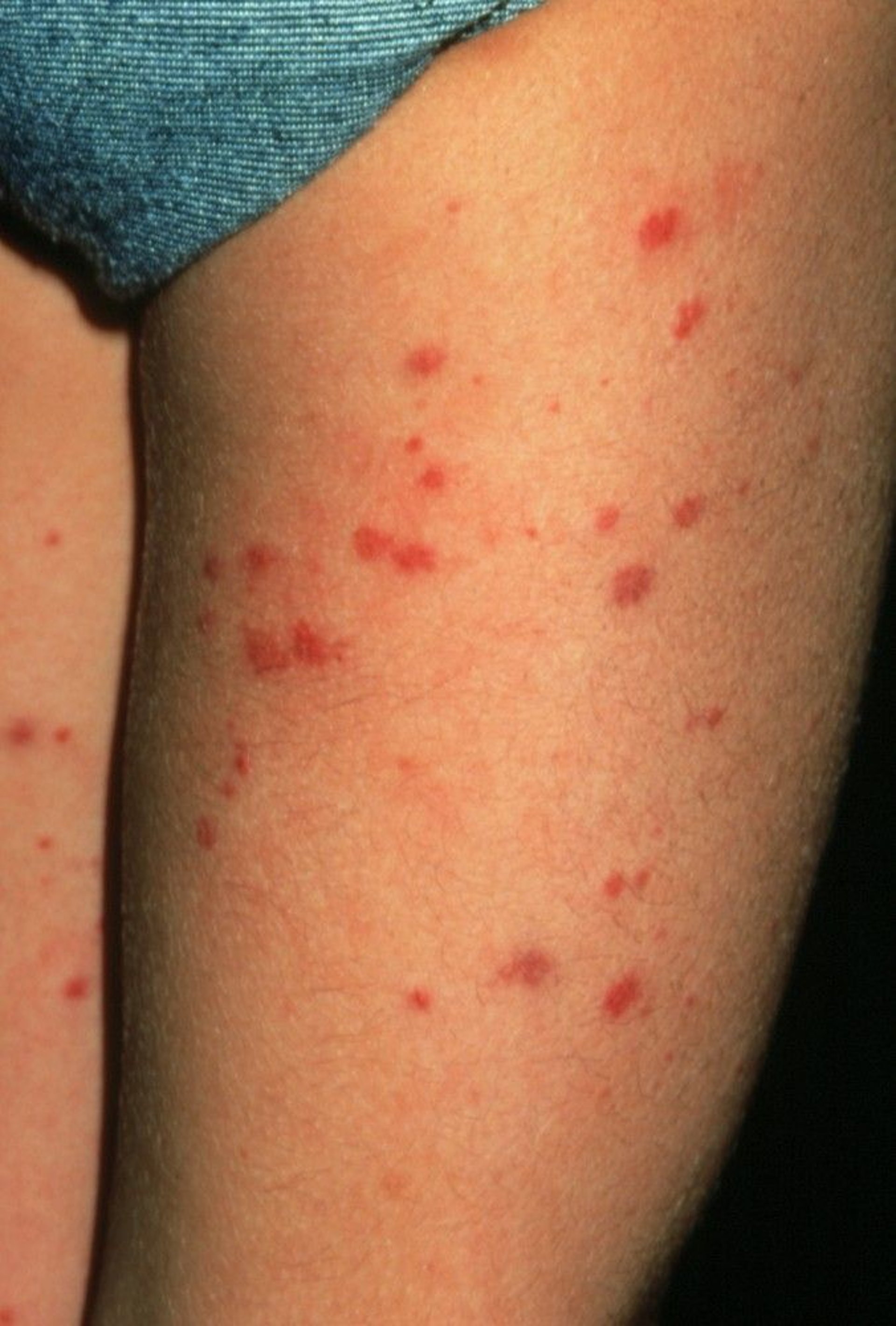 Immunoglobulin A–Associated Vasculitis (Henoch-Schönlein Purpura) (Legs)