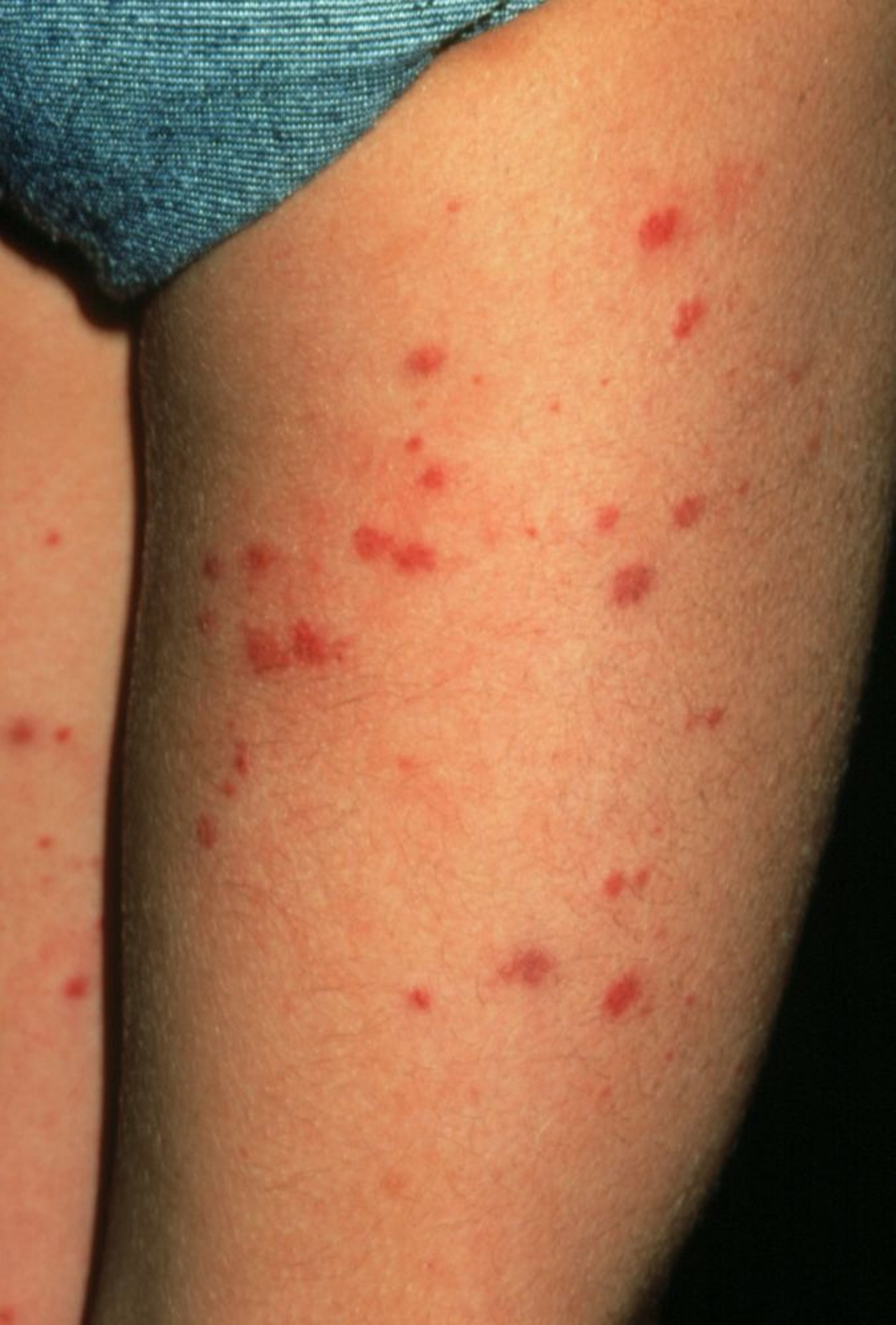 Vasculitis asociada a inmunoglobulina-A (denominada púrpura de Schönlein-Henoch) (Piernas)