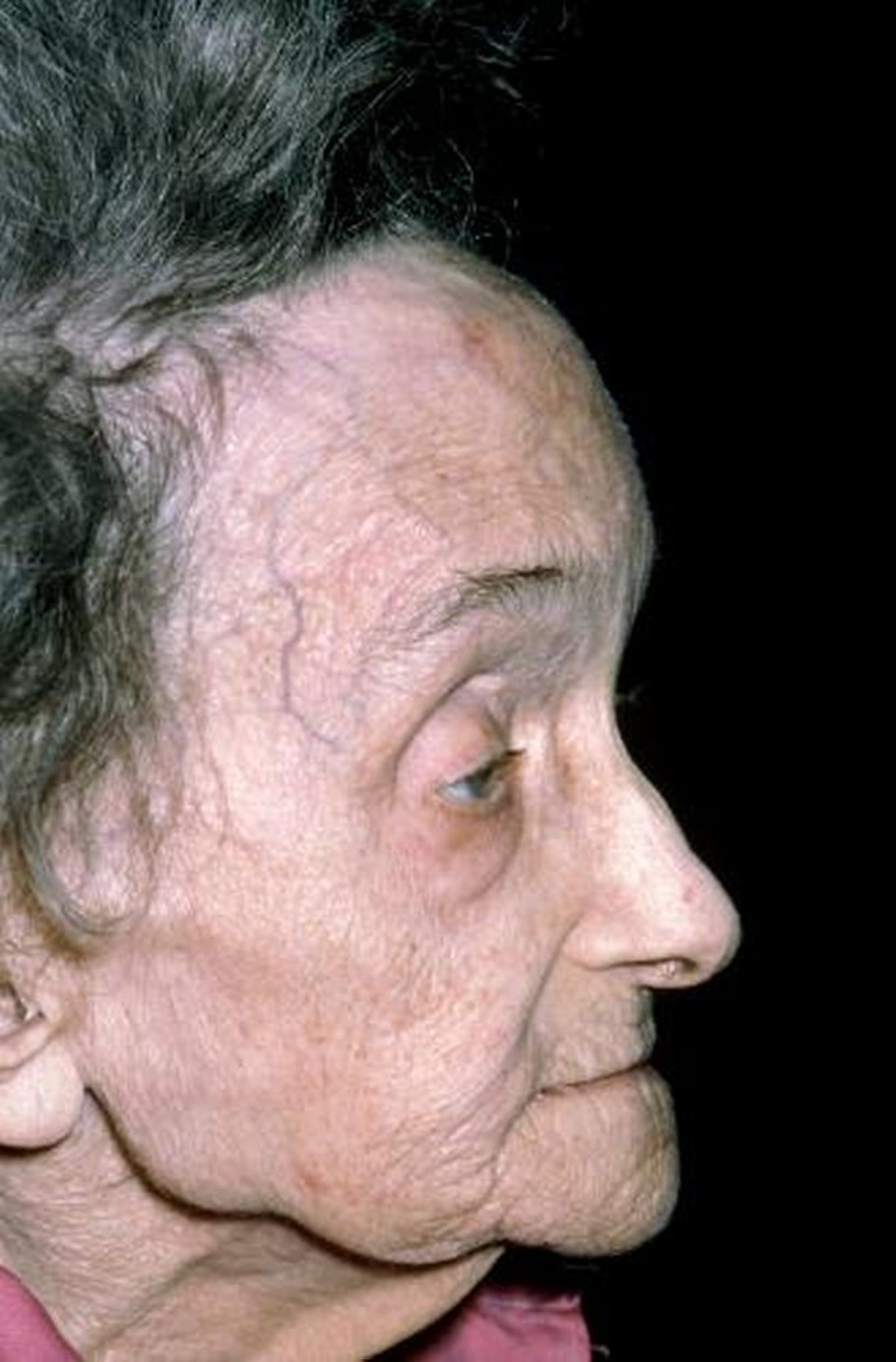 Vergrößerte Stirn bei Morbus Paget