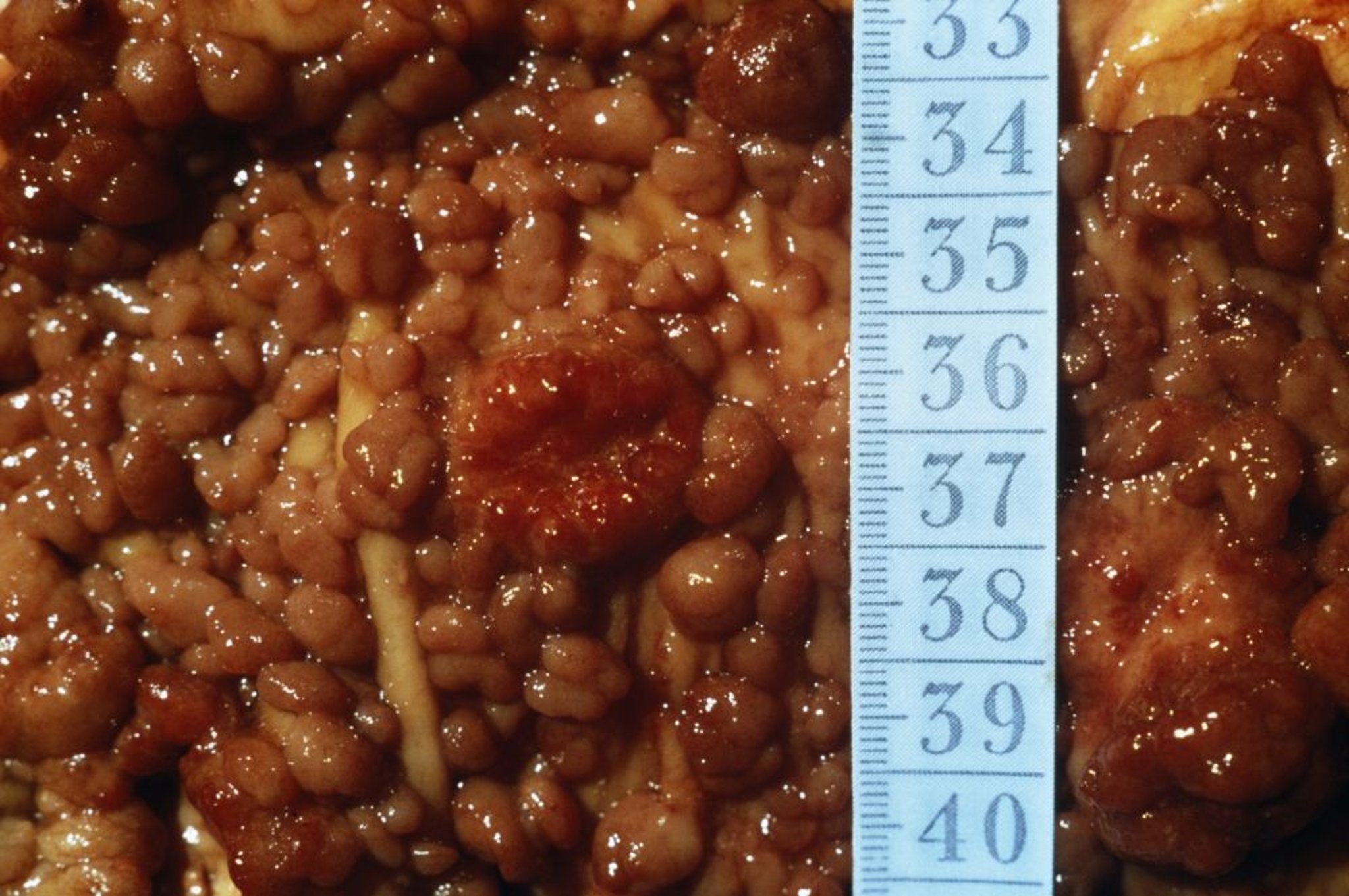 家族性腺瘤性息肉病