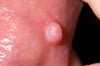 Oral Fibroma