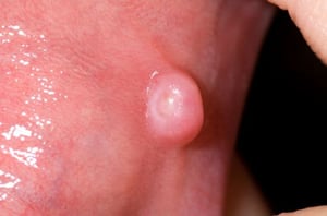 口腔内線維腫