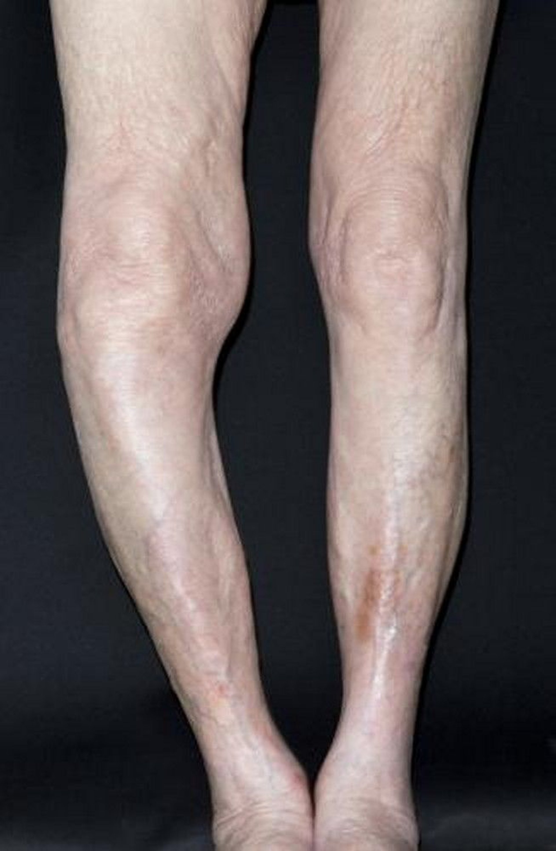 Bowing of the Shinbone in Paget Disease