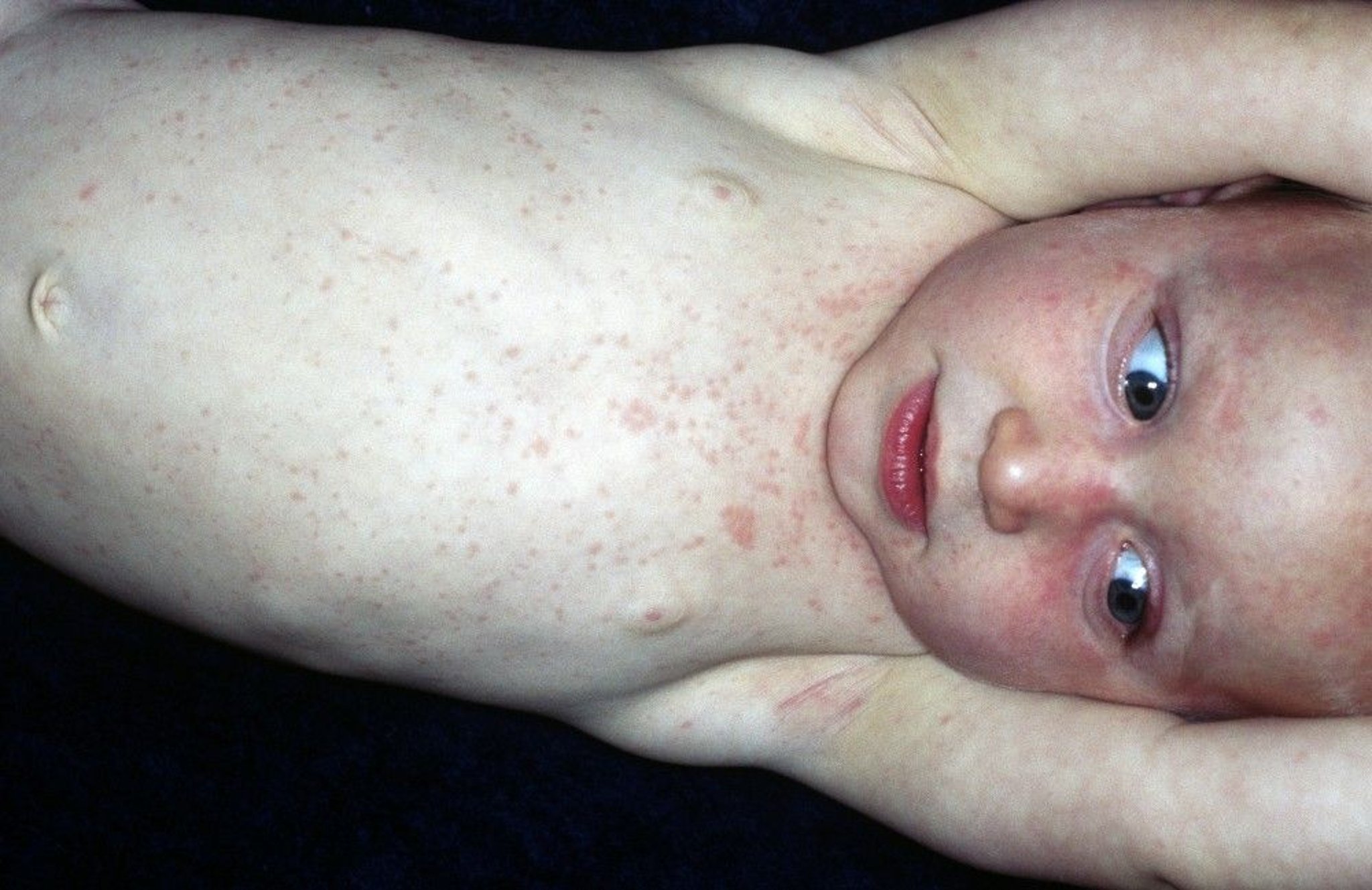 Rash Caused by Roseola Infantum