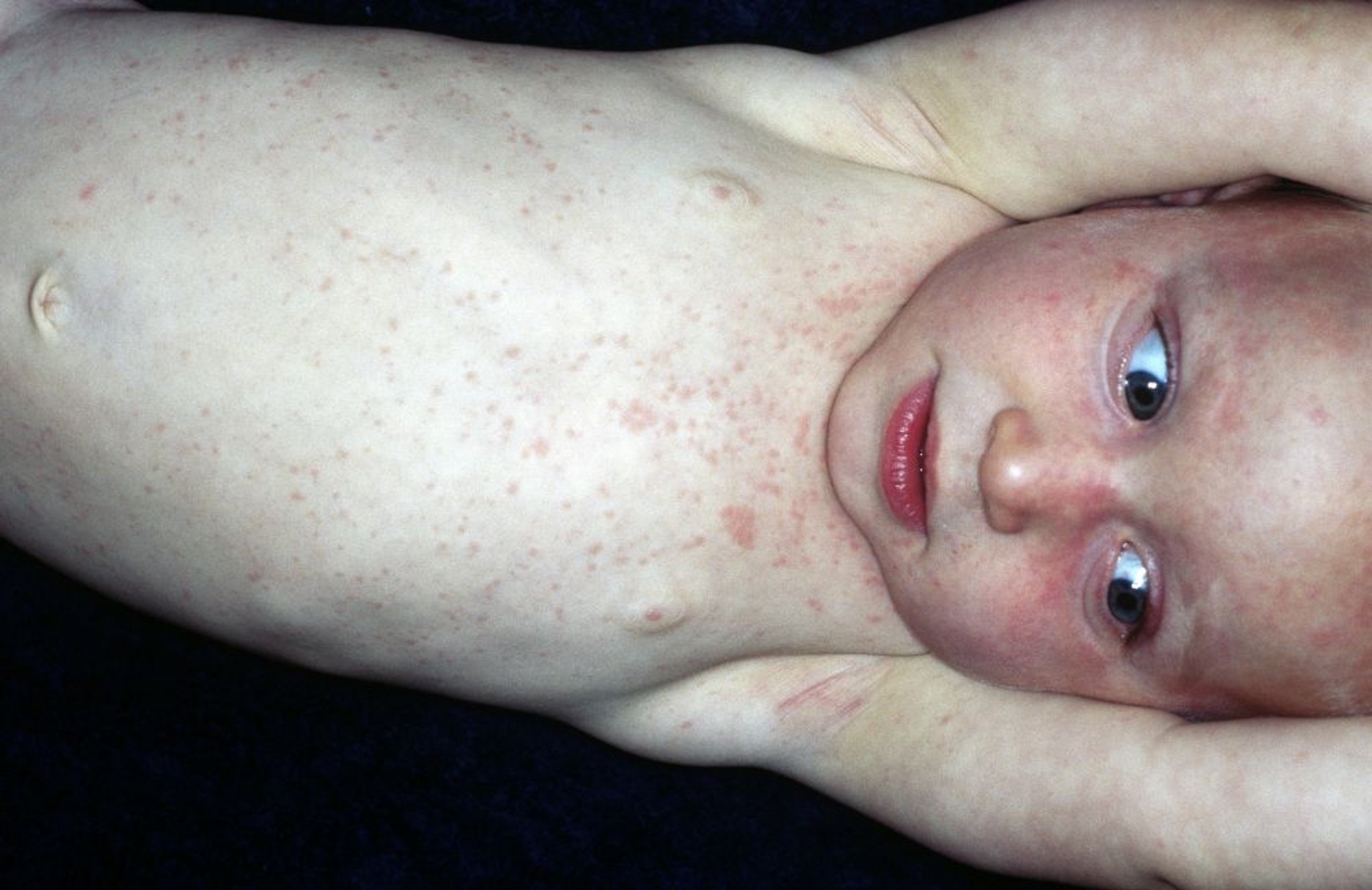 Durch Roseola infantum ausgelöster Ausschlag
