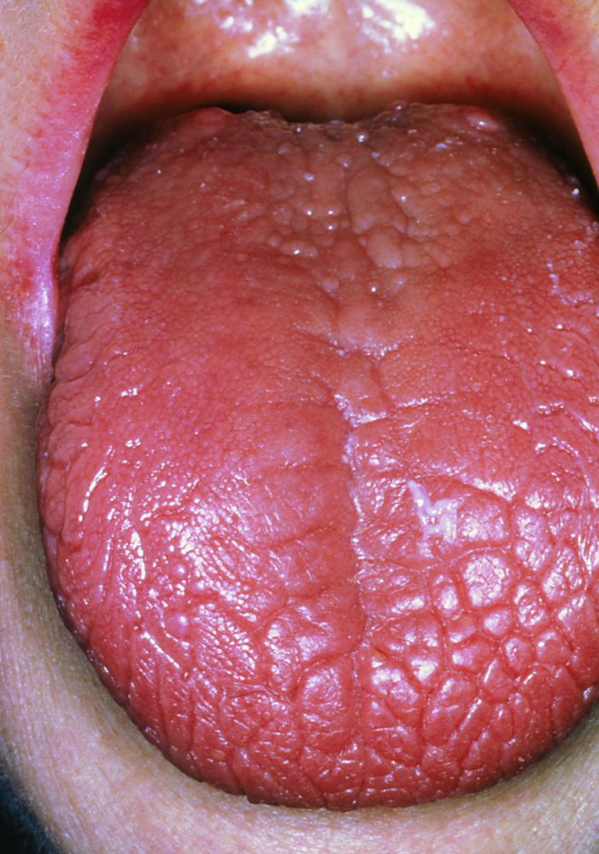 Sjögren-Syndrom (Zunge)