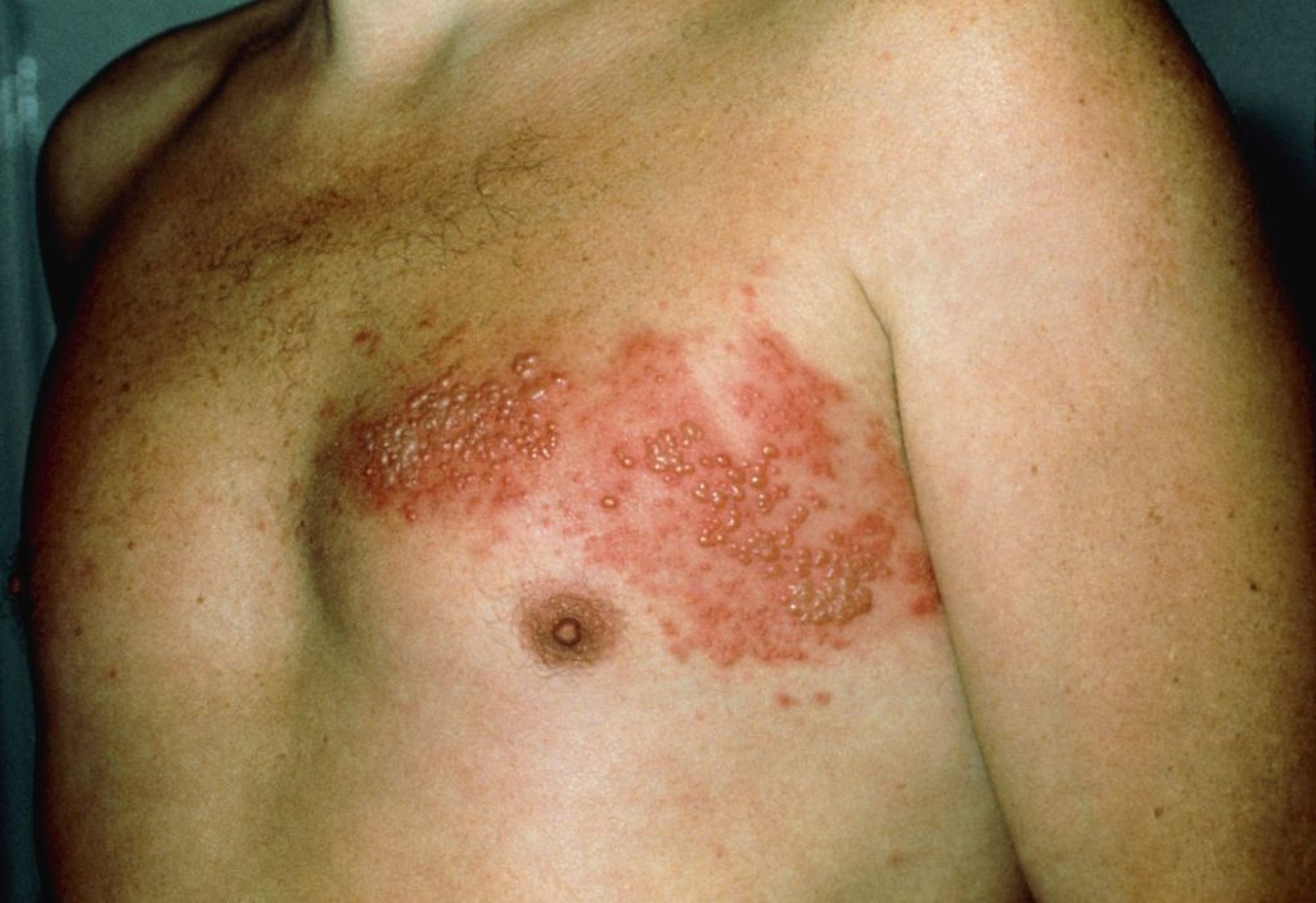 Erupção cutânea no tórax por herpes zóster