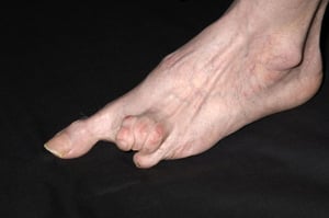 स्क्लेरोडर्मा (पैर)