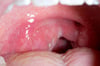 Peritonsillar Abscess