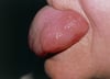 Angioedema de la lengua
