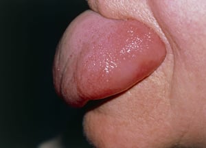 혀의 혈관 부종