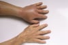 Wasp Sting Reaction
