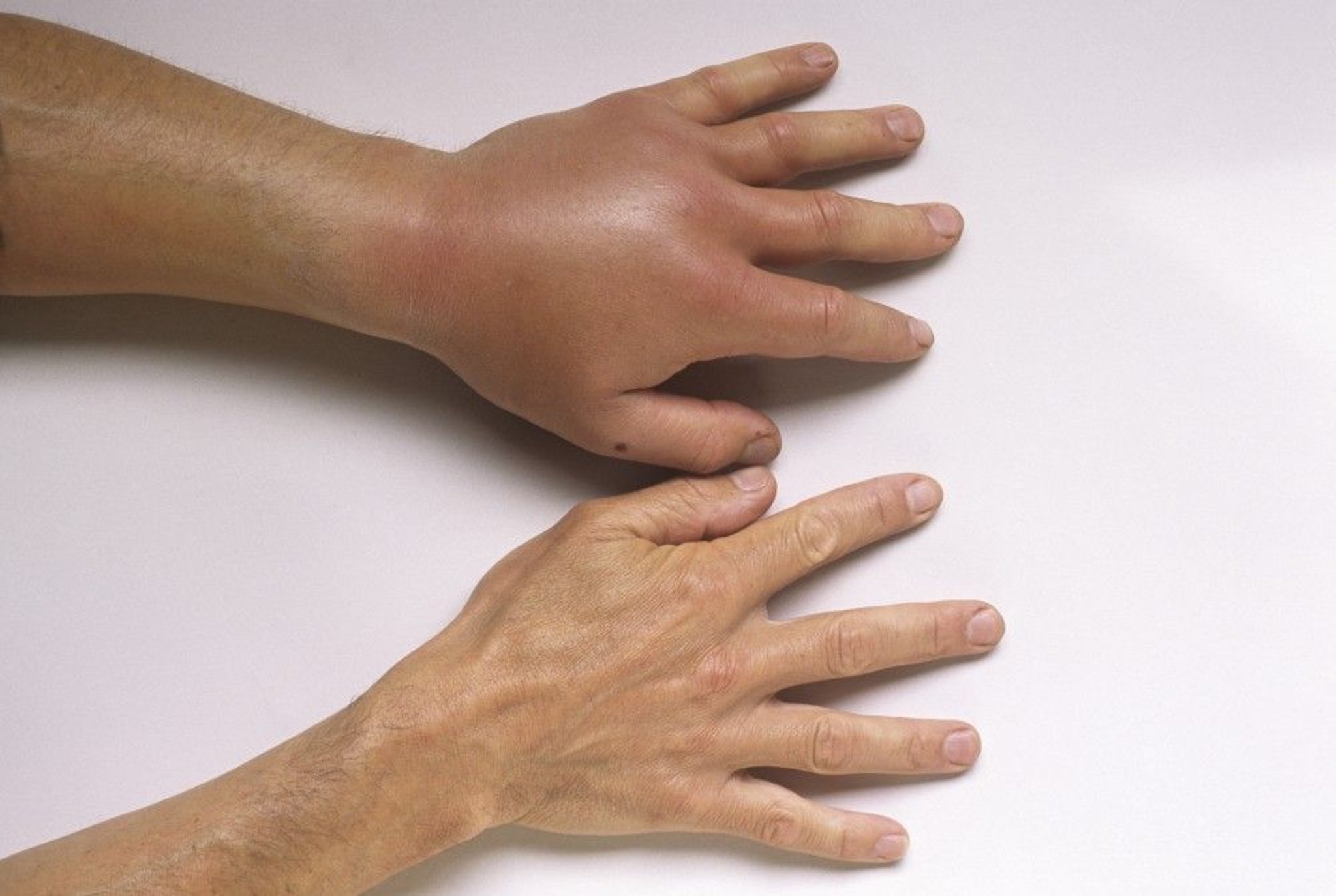 Wasp Sting Reaction