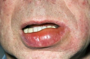 Angioödem der Lippen