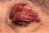 Black Eye