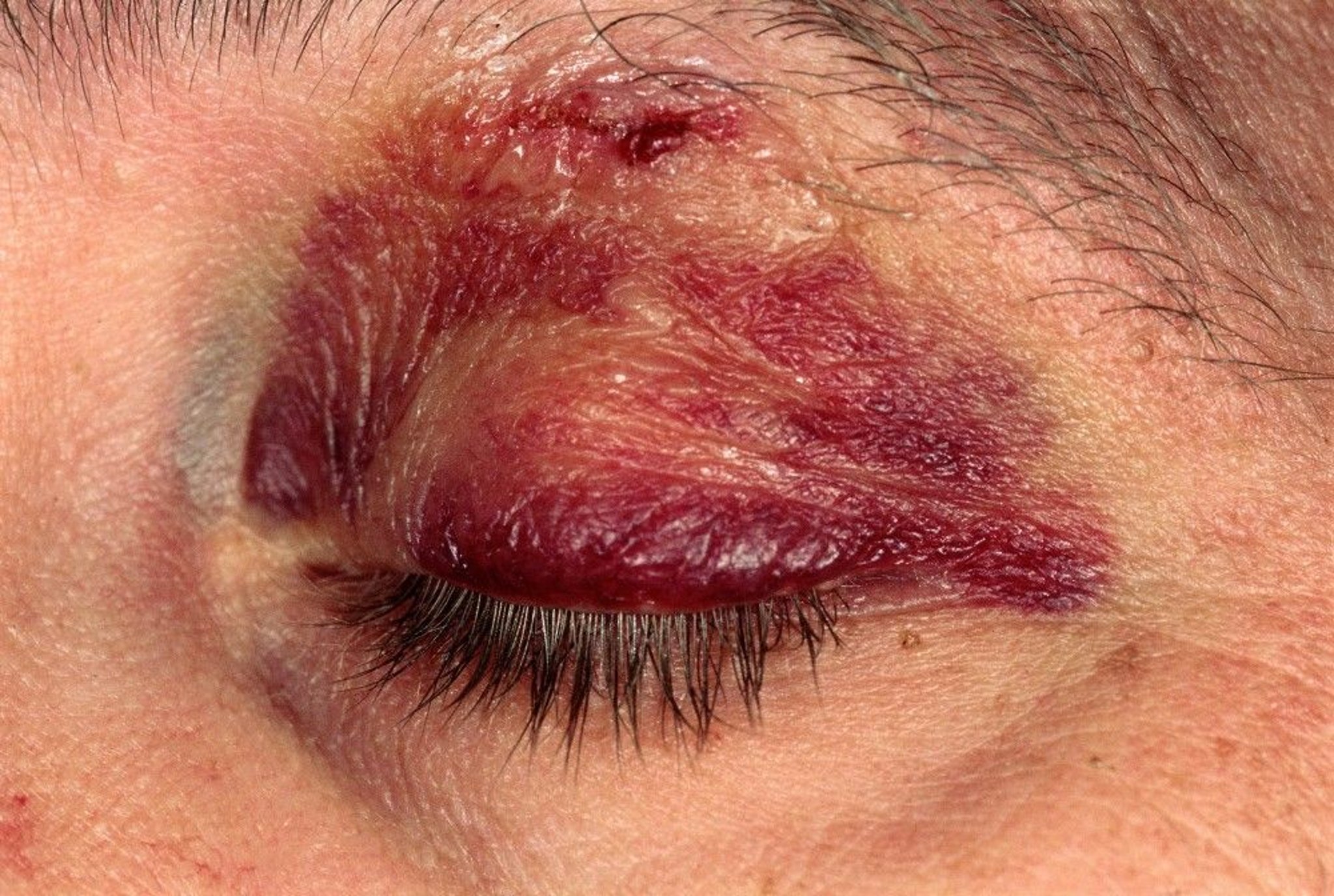 Black Eye