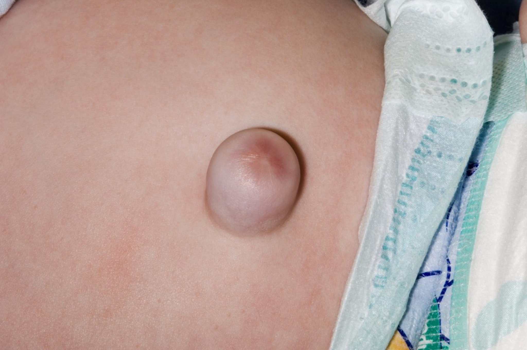 Umbilical Hernia