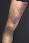 Equimosis (hematomas)
