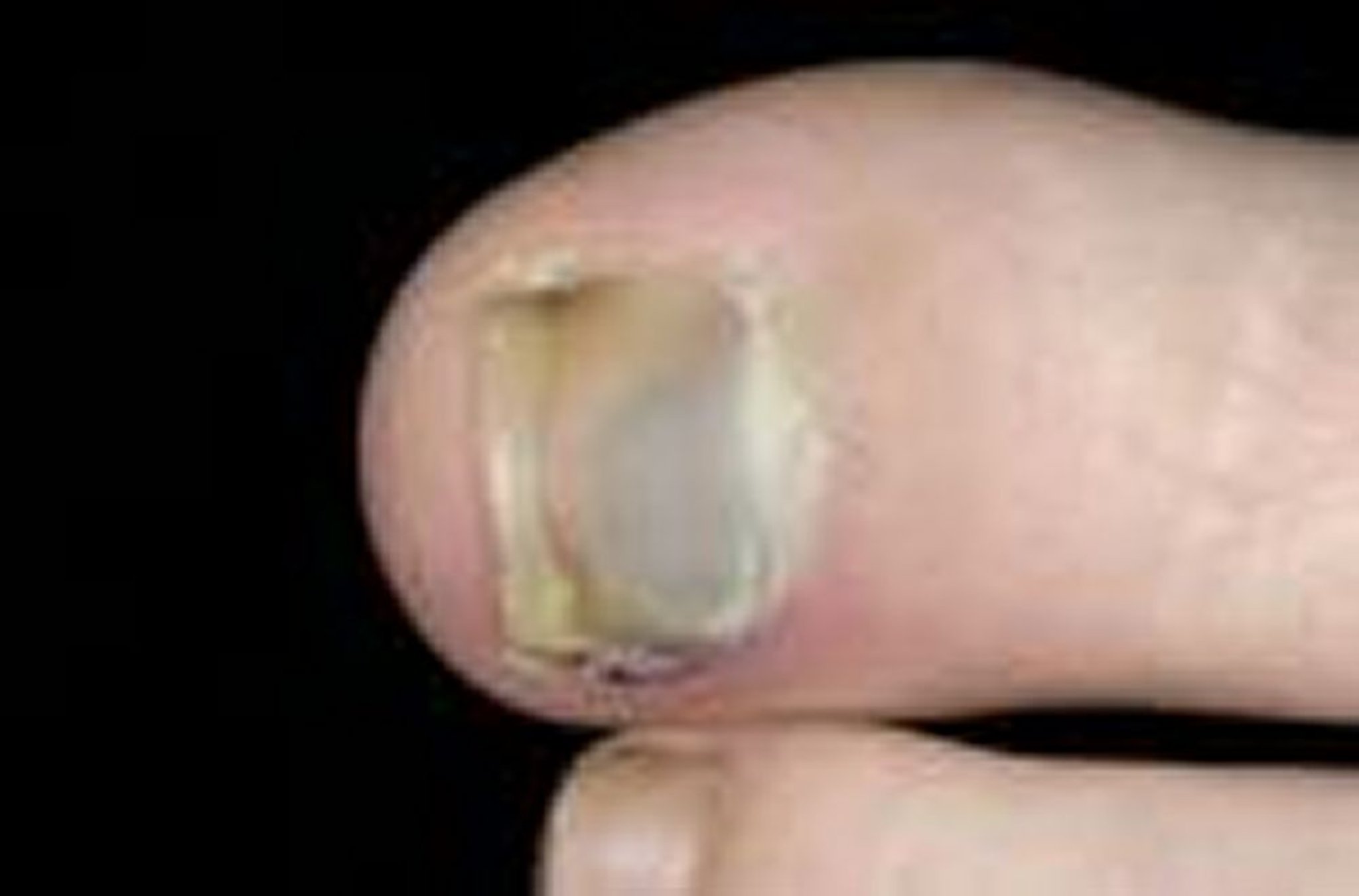 Hématome sous-unguéal (ongle de l’orteil)
