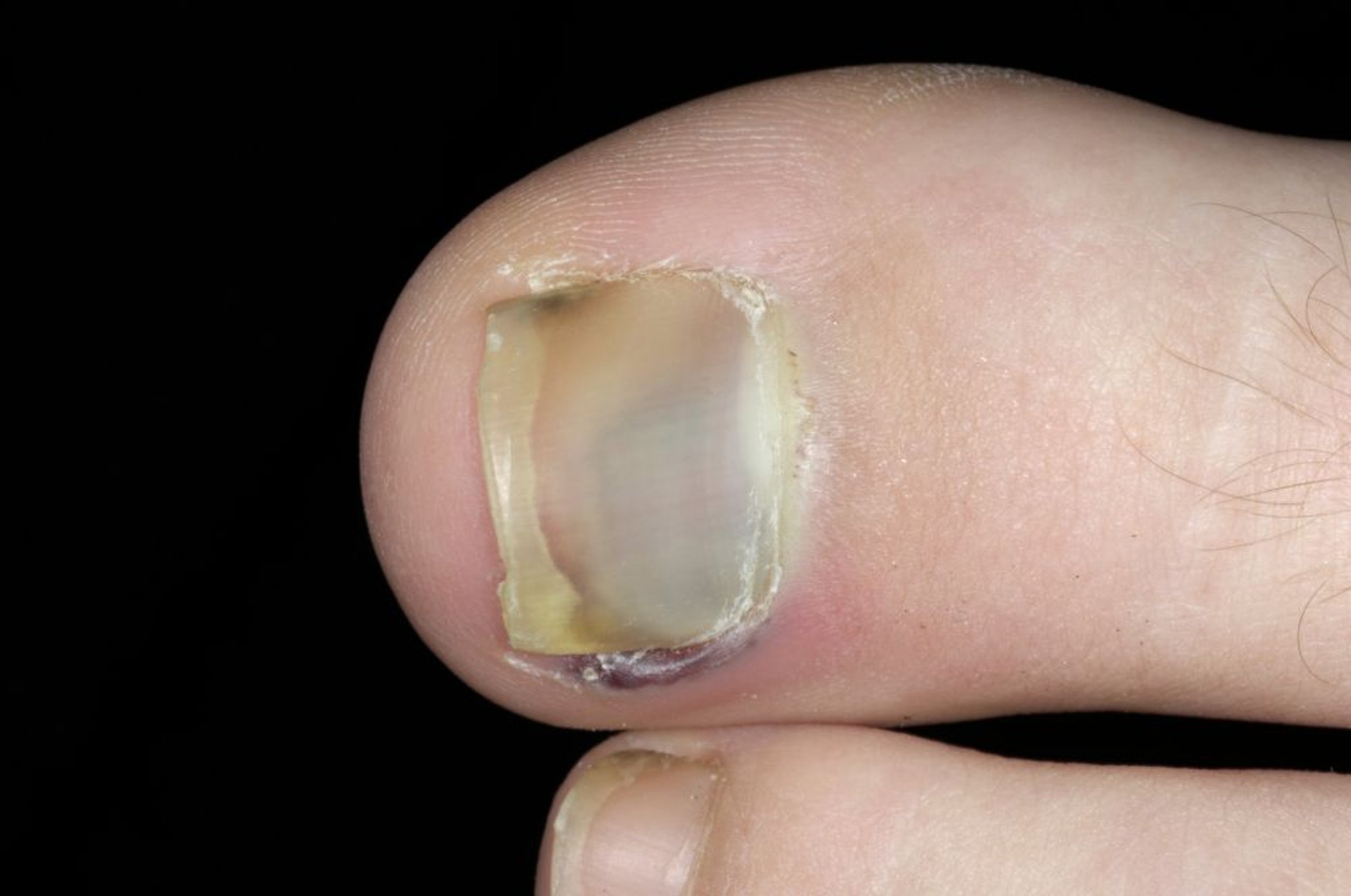 爪下血腫（足の爪）
