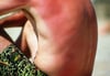 Mild Sunburn