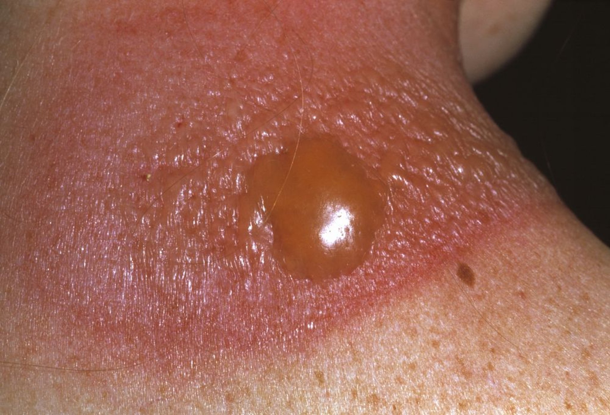 Schwerer Sonnenbrand