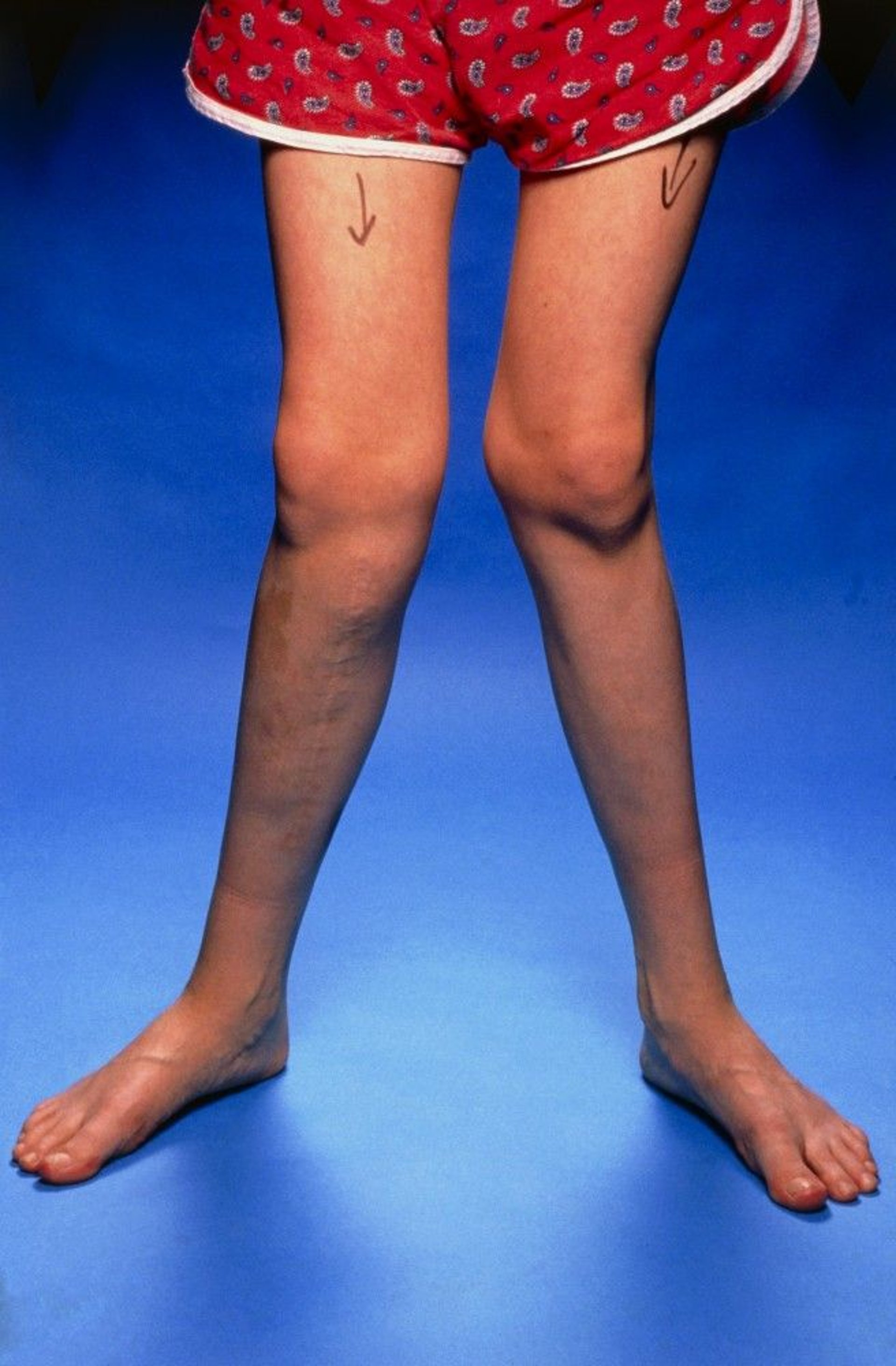 Knock-Knees (Genu Valgum)