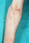 Venas quemadas