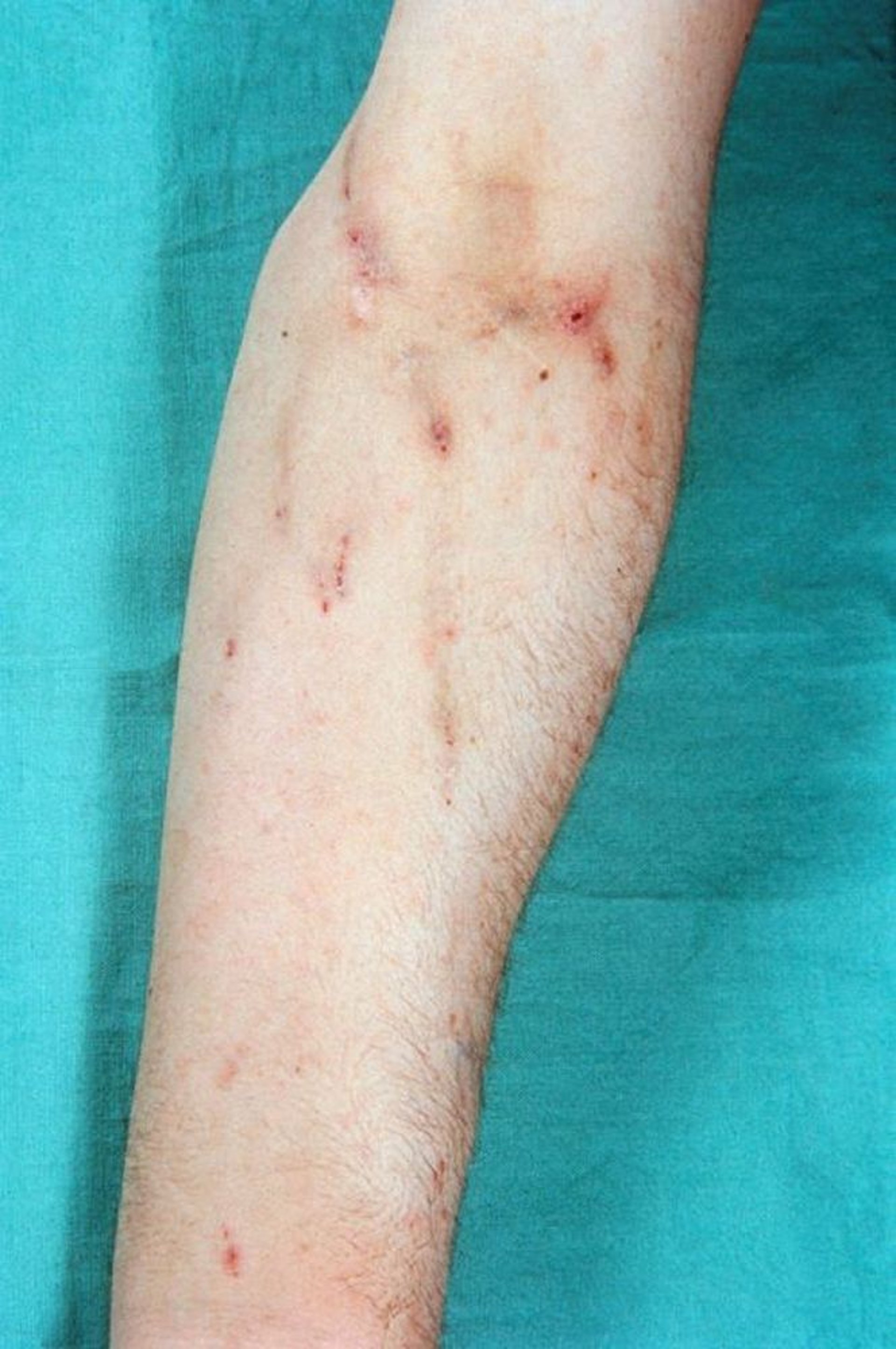 Traces d’injections