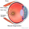 Macular Degeneration