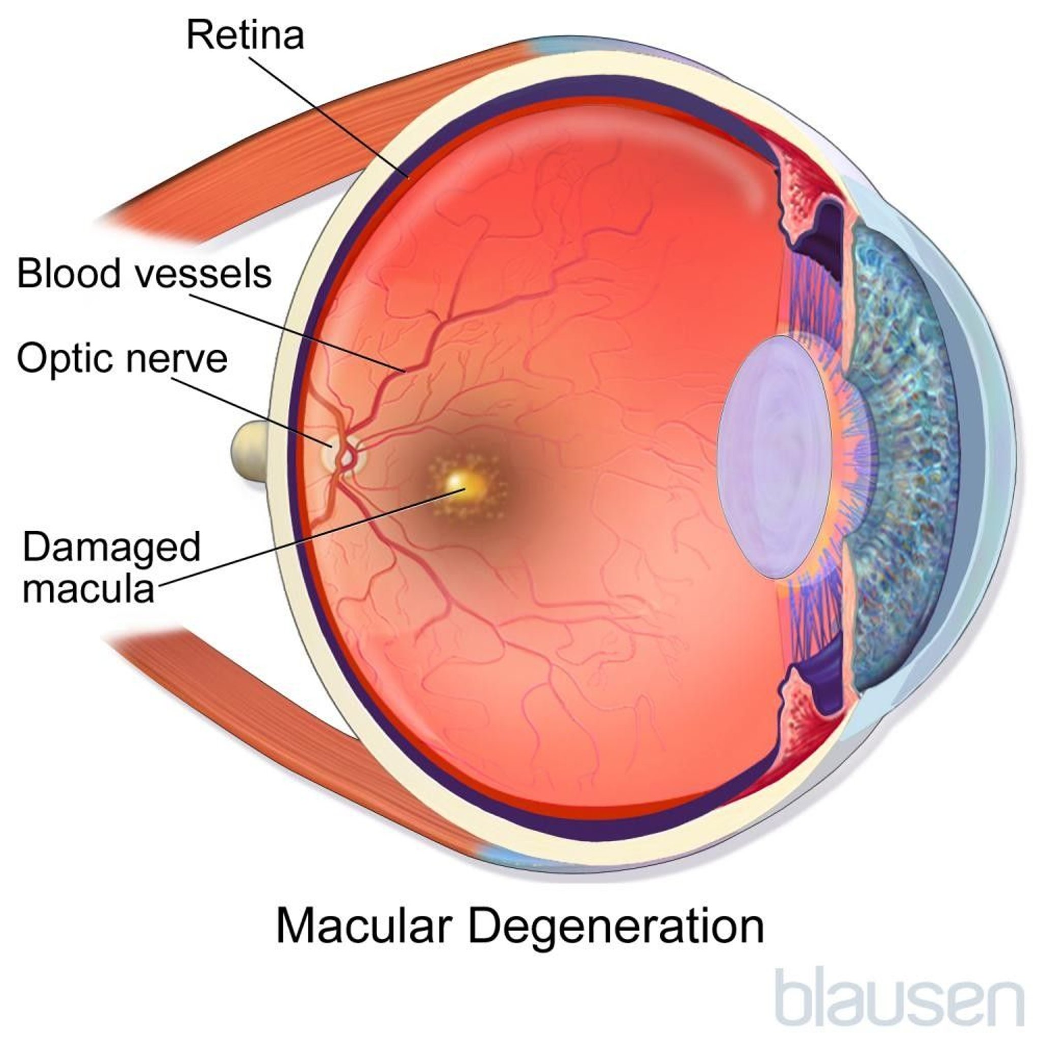 Macular Degeneration