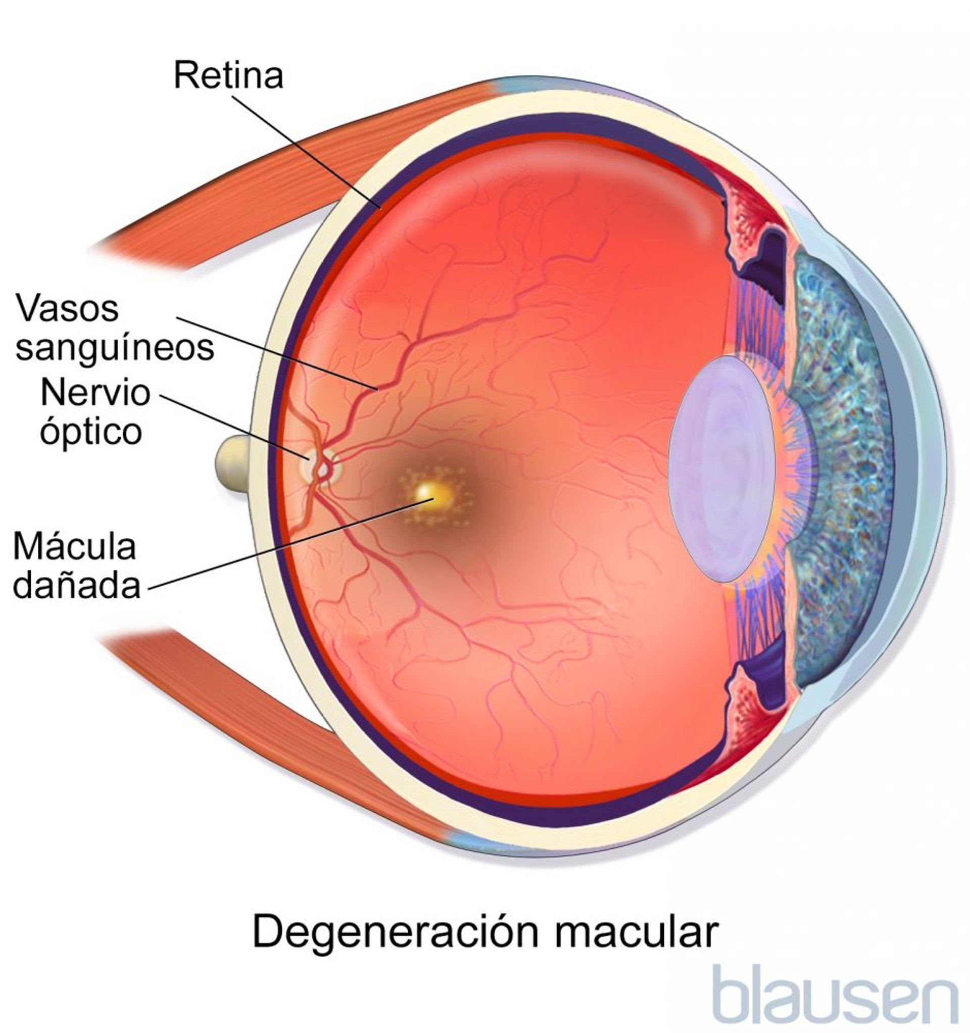 Degeneración macular