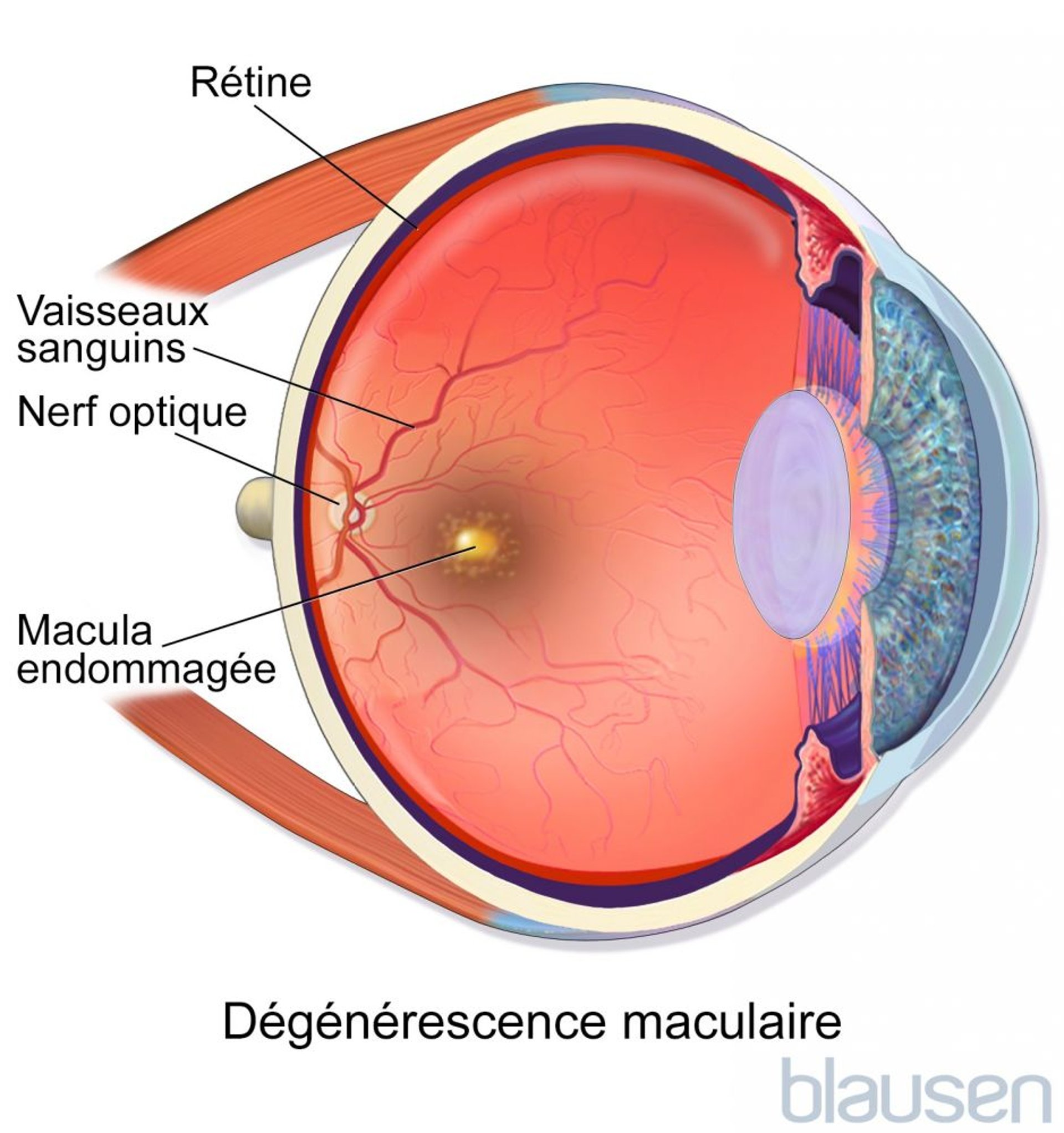 Dégénérescence maculaire