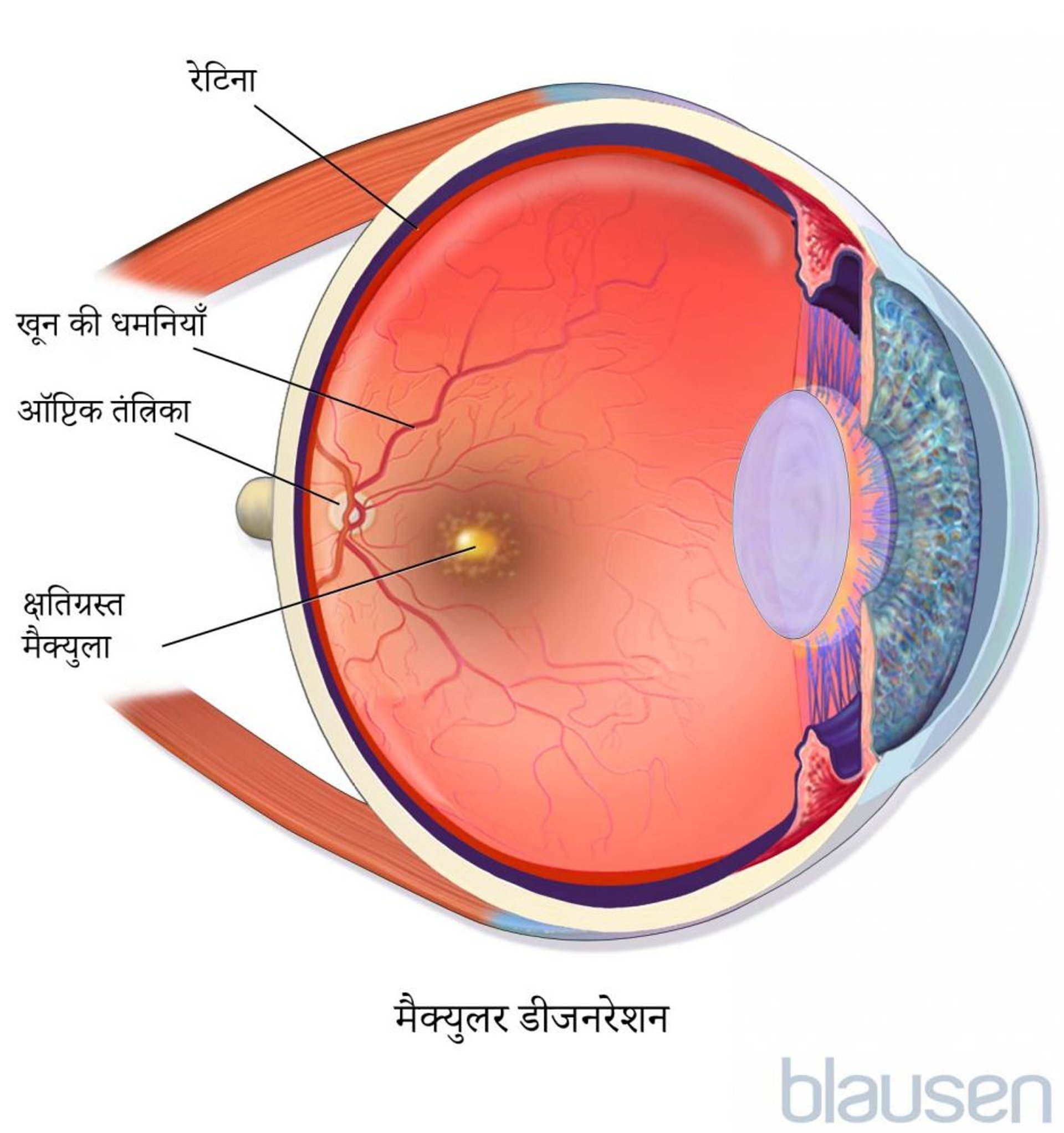 मैक्युलर डीजनरेशन
