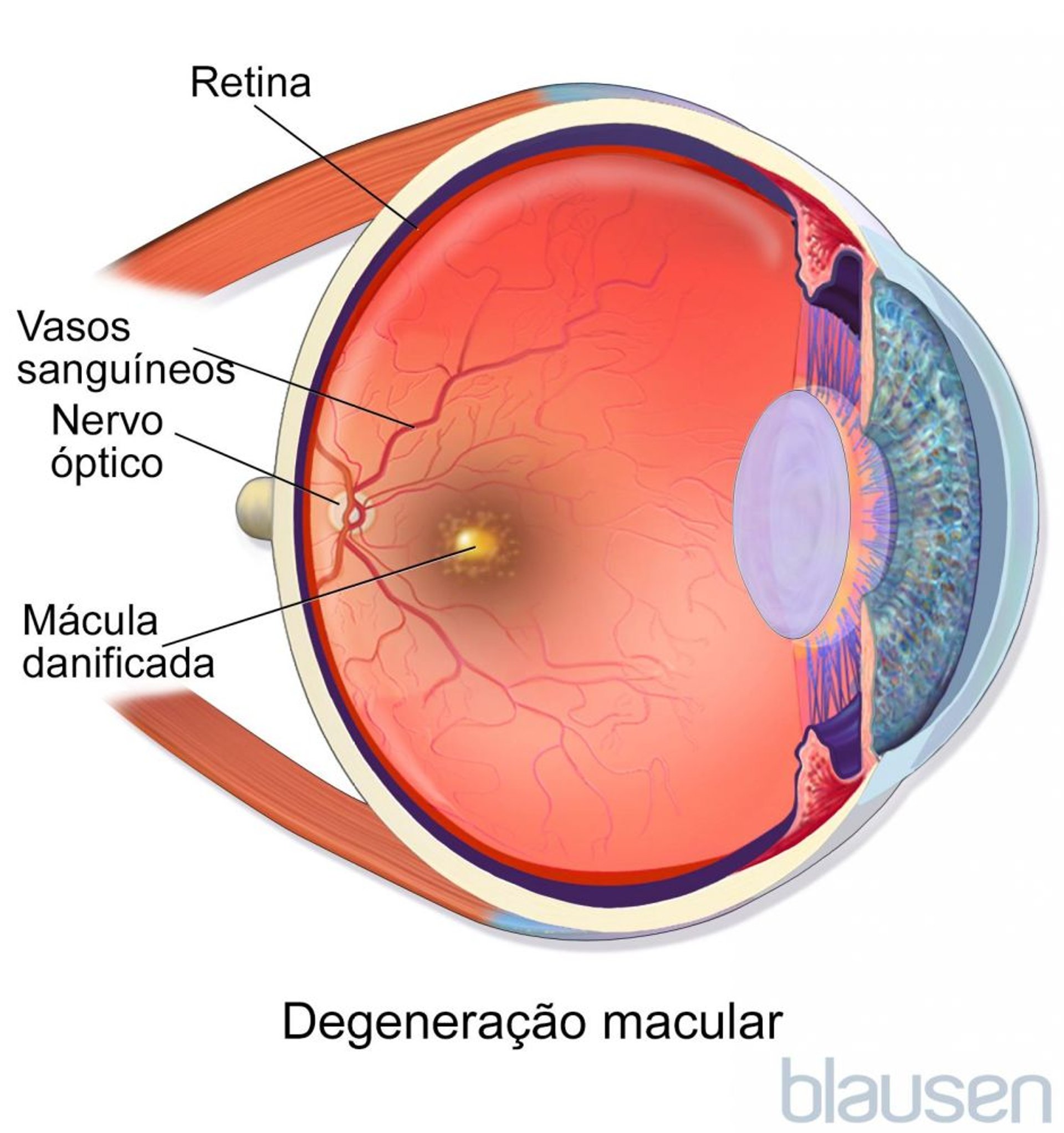Degeneração macular