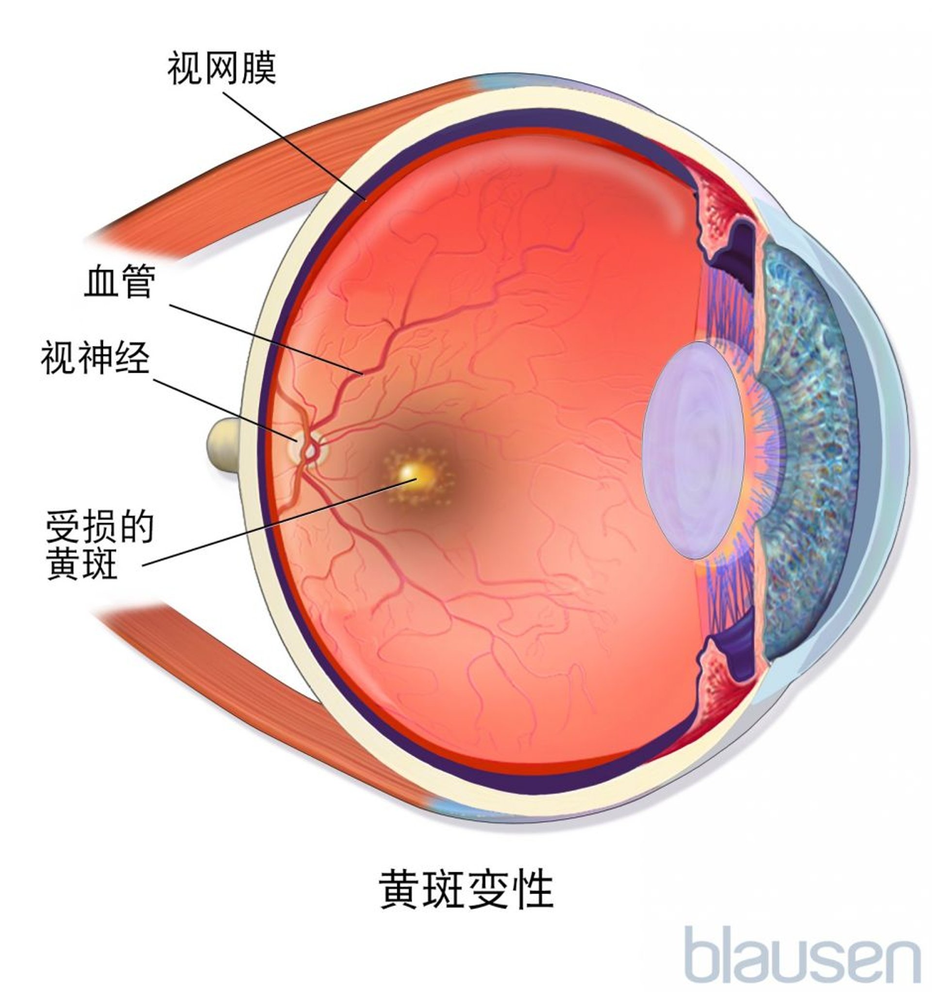 黄斑变性
